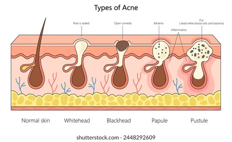 various acne types, from normal skin to inflamed pustules, for dermatological studies structure diagram hand drawn schematic vector illustration. Medical science educational illustration