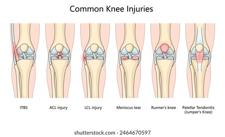 diversas lesiones comunes de rodilla, lesión de LCL, desgarro de menisco, rodilla de corredor y diagrama de estructura de tendinitis rotuliana Ilustración vectorial esquemática dibujada a mano. Ilustración educativa de ciencias médicas