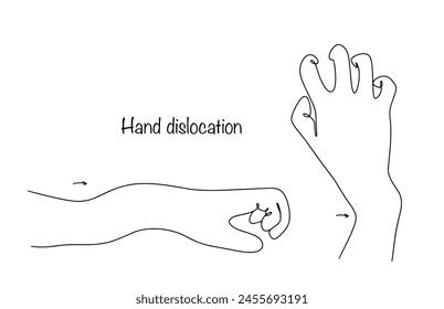 Verschiedene Luxationen des menschlichen Handgelenks. Verlagerung von Gelenken als Folge eines traumatischen Aufpralls. Isolierte Vektorgrafik auf weißem Hintergrund.