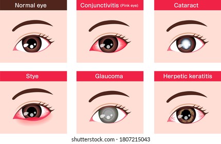 Various eye diseases vector illustration ( female eye )