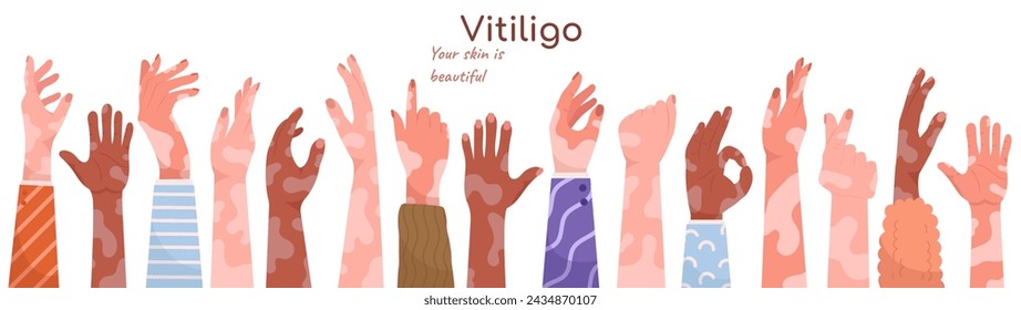 Various human hands with vitiligo depigmentation dermatology disease set vector illustration. Male and female arms with genetic skin disorder design elements for problem world day awareness poster
