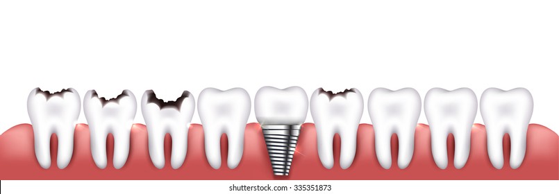 Various teeth conditions healthy, caries and dental implant.