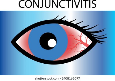 Diversos tipos de enfermedades oculares. glaucoma, calcinación, conjuntivitis, alergia ocular