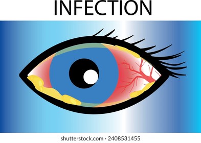 
Diversos tipos de enfermedades oculares. glaucoma, calcinación, conjuntivitis, alergia ocular, infección