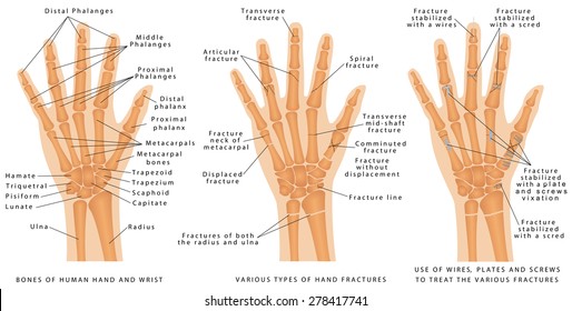  Various types of hand fractures. Fractures of both the radius and ulna. Displaced Fracture and Fracture without displacement. Use of wires, plates and screws to treat the various fractures