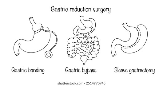 Verschiedene Möglichkeiten, Magenvolumen durch medizinische Intervention zu reduzieren. Magenreduktion Chirurgie, um Gewicht für den Patienten zu verlieren oder gefährliche Krankheiten zu behandeln.Vektorgrafik.
