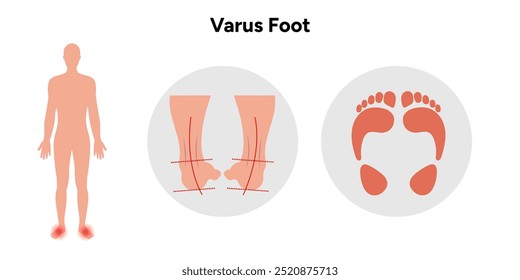 Varus pé e pegada. Diagrama ortopédico infográfico