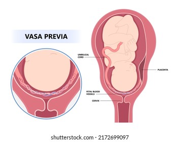 La condición de que los vasos sanguíneos del cordón umbilical atraviesen el trastorno de las membranas amnióticas en