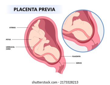 vasa previa fetal infant baby born c section nuchal cord twins fetus defect vessels funic labor growth low lying birth fluid of PROM test increta cervix Bilobed sac uterus neck knotted Contraction