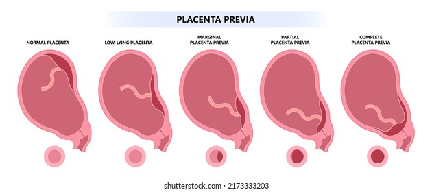 Clasificación de la placenta desprendida del útero del embarazo antes del parto de una anatomía del recién nacido en medicina