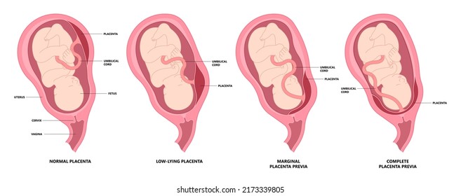 vasa previa fetal infant baby born c section nuchal cord twins fetus defect vessels funic labor growth low lying birth fluid of PROM test increta cervix Bilobed sac uterus neck knotted Contraction