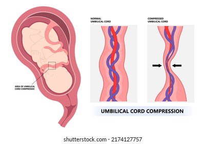 Vista frontal del feto con compresión del cordón umbilical las anomalías en el embarazo