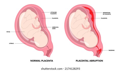 Vasa Previa Fetal Infant Baby Born C Section Nuchal Cord Twins Fetus Defect Vessels Funic Labor Growth Low Lying Birth Fluid Of PROM Test Increta Cervix Bilobed Sac Uterus Neck Knotted Contraction