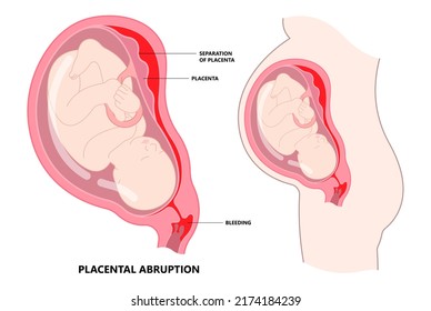 vasa previa fetal infant baby born c section nuchal cord twins fetus defect vessels funic labor growth low lying birth fluid of PROM test increta cervix Bilobed sac uterus neck knotted Contraction