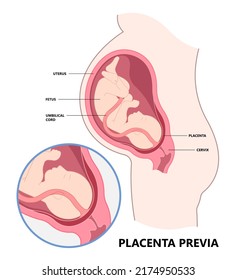 Vasa Previa Fetal Infant Baby Born C Section Nuchal Cord Twins Fetus Defect Vessels Funic Labor Growth Low Lying Birth Fluid Of PROM Test Increta Cervix Bilobed Sac Uterus Neck Knotted Contraction