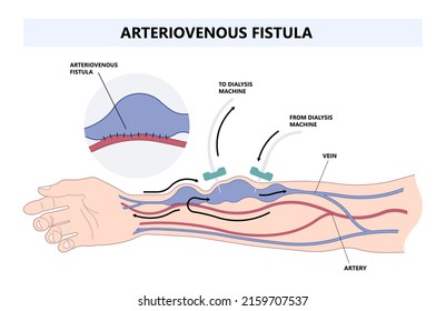 Vascular Access Kidney Graft Shunt Lumen PICC Line Tube Chest Care Artery Vein Arm Blood Vessel Flow Neck Liver CRRT Intravenous Injection Total Nutrition