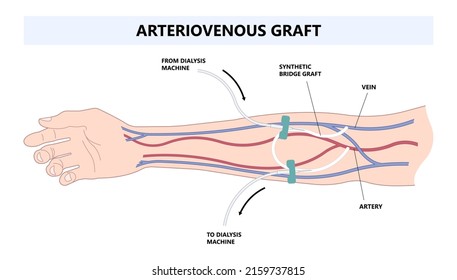 Vascular access kidney graft shunt lumen PICC line tube chest care artery vein arm Blood vessel flow neck liver CRRT intravenous injection Total Nutrition