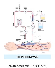 Vascular Access Kidney Graft Shunt Lumen PICC Line Tube Chest Care Artery Vein Arm Blood Vessel Flow Neck Liver CRRT Intravenous Injection Total Nutrition