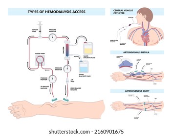 Vascular Access Kidney Graft Shunt Lumen PICC Line Tube Chest Care Artery Vein Arm Blood Vessel Flow Neck Liver CRRT Intravenous Injection Total Nutrition