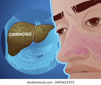 Vascular spider. Signs of liver cirrhosis. Signs of liver disease. Healthcare illustration. Vector illustration.