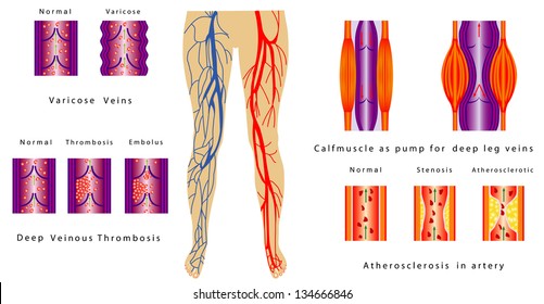 Vascular System Legs. Atherosclerosis In Artery. Deep Venous Thrombosis. Varicose Veins. Calf Muscle As Pump For Deep Leg Veins. Chronic Venous Insufficiency.