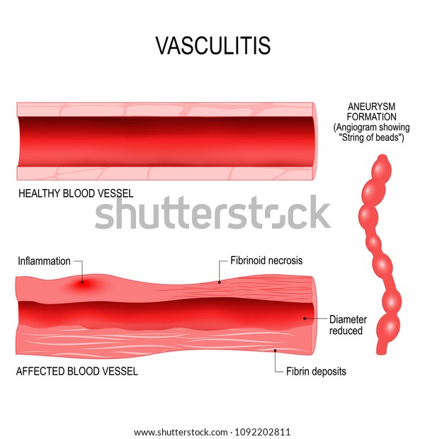 血管炎は炎症による血管の損傷である 患者の横断 健康な血管 動脈瘤形成 のベクター画像素材 ロイヤリティフリー