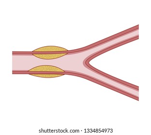 Vasculitis is a group of disorders that destroy blood vessels by inflammation.