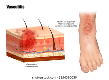 La vasculitis implica inflamación de los vasos sanguíneos. Petequias y púrpura en la extremidad inferior debido a vasculitis inducida por la medicación. Linfangitis
