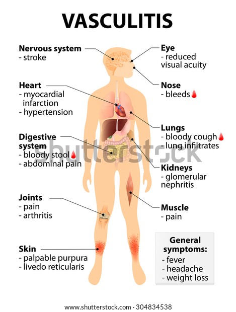 No inflamatoria vasculitis