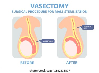 Vasectomy Male Sterilisation Ejaculate Contraceptive Genitalia Sterilisation Operation Method Medical Genital Cut System	