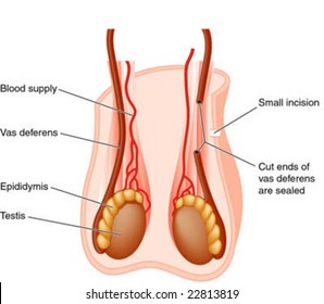 Vasectomy Operation
