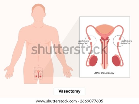 Vasectomy is a permanent surgical method of male birth control that involves cutting and sealing the vas deferens to prevent sperm from entering semen thus making sterile and preventing pregnancy. 