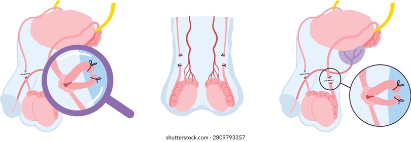 Vasectomy surgery anatomical vector illustration set with diagram showing close up of vas deferens cutting site
