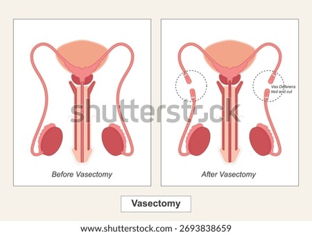 Vasectomy is a surgical procedure for permanent contraception in men involving cutting or sealing the vas deferens (the tubes that carry sperm).Medical health care , vector illustration.