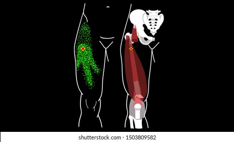 Vastus Intermedius Trigger Point. Leg pain