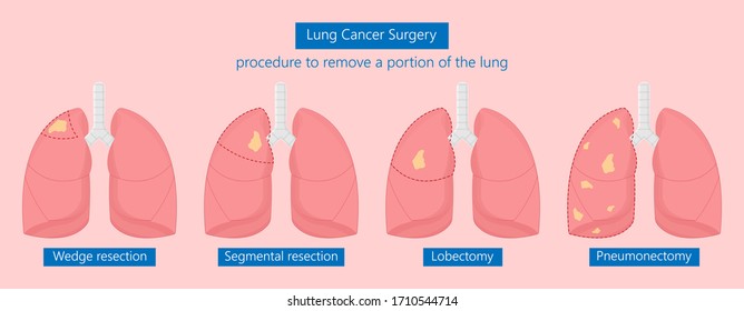 VATS lung cancer treatment sub pus tap cell open tube COPD RATS Wedge treat tumor lobar blebs chest video robot space drain fluid remove tissue biopsy nodule cavity pleura trauma injury surgery