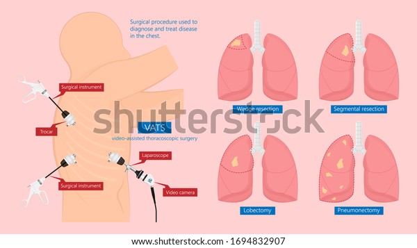 Vats Lung Cancer Treatment Sub Pus Stock Vector Royalty Free 1694832907