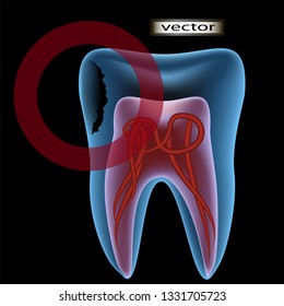 Vector 3D illustration of a clipart caries affected tooth under x-ray with a view of the pulp and nerve translucent contour of the tooth three-dimensional image for the dentist's office, doctor.