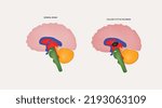 Vector 3d illustration of normal brain and brain with colloid cyst. Can use for medical education, articles and  blog.