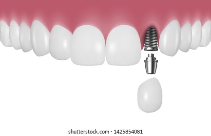 Vector 3d Realistic Render Human Teeth with Implant Closeup Isolated on White Background. Dentistry and Orthodontics Design. Human Teeth for Medical Prosthetics Concept