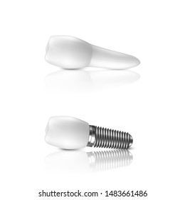 Vector 3d Realistic Render White Tooth and Implant Denture in Horizontal Closeup Isolated on White Background. Dental, Medicine and Health Concept. Design Template of Prosthesis Structure. Front View