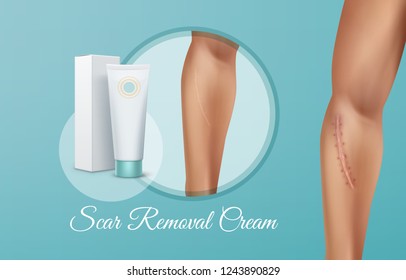 Vector ads illustration of realistic scar removal cream in white tube with packaging isolated on background, comparison of fresh and healed wounds on man hand after surgery