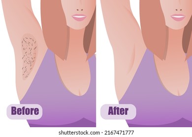 Vector Armpit Laser Hair Removal Result, Before And After Procedure, Girl Smooth Skin, Body Hair Removal Procedure, Beauty Salon Banner