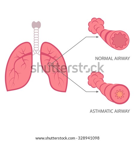 vector asthma illustration, bronchial, lungs respiratory disease,