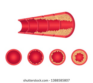 Icono de concepto de aterosclerosis vectorial. Enfermedad colesterol vascular. Venas, trombosis arterial, enfermedad de los glóbulos rojos. Elementos de diseño de afiches para la toma de conciencia sobre problemas médicos relacionados con la salud. Ilustración aislada