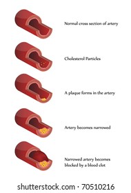 Vector Atherosclerosis illustration. High cholesterol.  Blood clot.