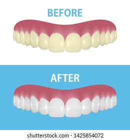 Vector Background with 3d Realistic Render Denture Set Closeup Isolated. Dentistry and Orthodontics Design. Human Teeth for Medical and Toothpaste Concept. Healthy Oral Hygiene, Jaw Prosthesis