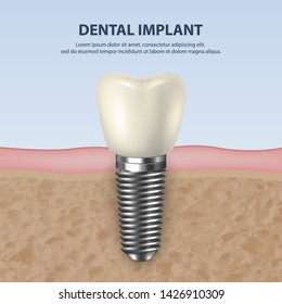 Vector Background with 3d Realistic Render White Tooth Implant Denture Closeup. Dental, Medicine and Health Concept. Design Template of Prosthesis Structure. Front View