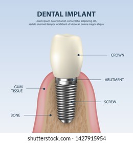 Vector Background with 3d Realistic Render White Tooth Implant Denture Closeup. Dental, Medicine and Health Concept. Design Template of Prosthesis Structure. Front View