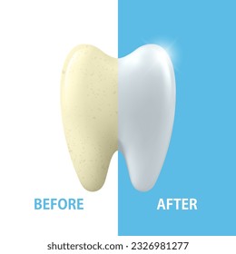 Vector Banner with 3d Realistic Tooth Closeup. Cleaning Concept - Before and After Hygienic Teeth Cleaning. Dentistry Design. Medical, Toothpaste Advertisement. Healthy Oral Hygiene, Teeth Whitening